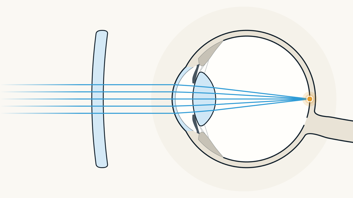 Illustration of an eyeglass lens in front of an eye seen from the side: light passes through the lens, then comes to a focus on the retina.