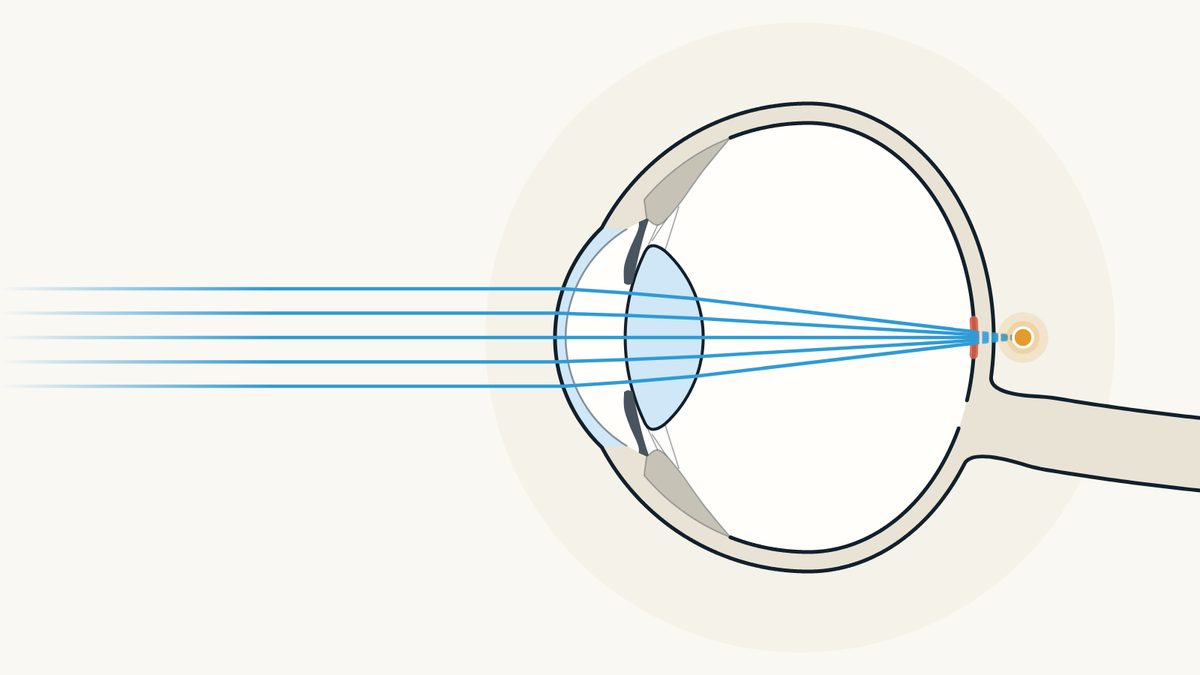 Illustration of a farsighted eye seen from the side: light comes to a focus behind the retina.