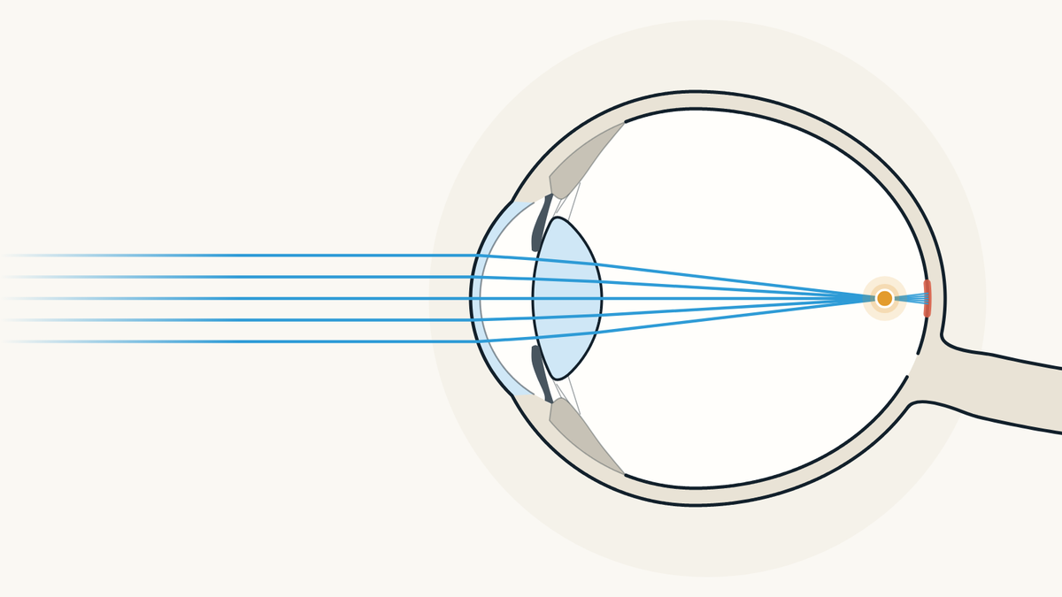 Illustration of a nearsighted eye seen from the side: light comes to a focus in front of the retina.