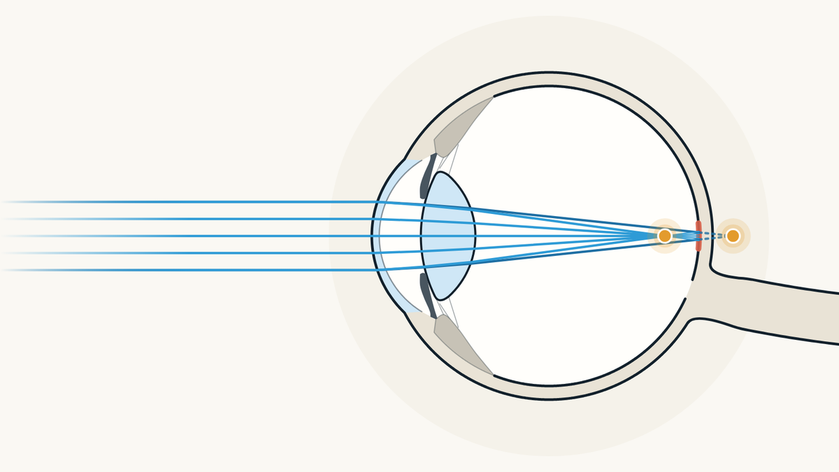 Illustration of an astigmatic eye seen from the side: the cornea or lens bends light unevenly in different directions, so light doesn't focus properly on the retina.