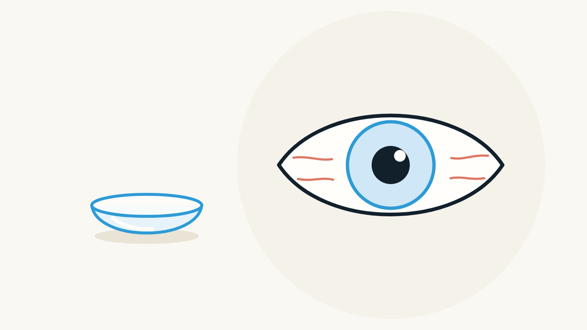 Œil rouge avec des verres de contact : quoi faire et quand appeler