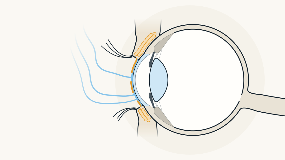 Illustration of an eye seen from the side with its eyelids: the oily layer of the tear film is torn in two places and tears evaporate from the surface of the eye in rising wisps.