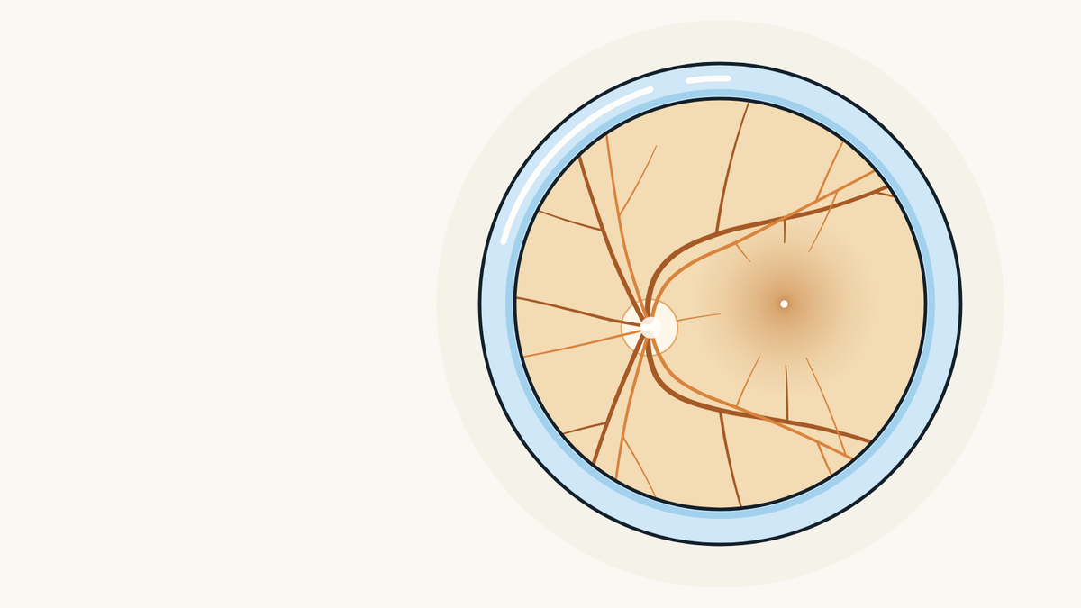 Illustration of the back of the eye seen through an examination lens: the retina, the optic nerve and the small blood vessels.